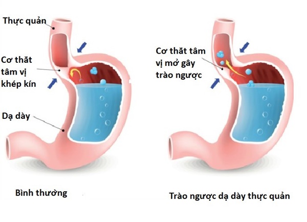 Nguy cơ ung thư từ căn bệnh dạ dày, thực quản phổ biến ở Việt Nam-1