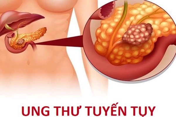 Triệu chứng ung thư tuyến tụy giai đoạn đầu-1