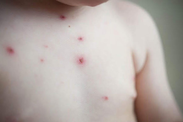 Hà Nội xuất hiện bệnh thủy đậu trái mùa ở hàng loạt người lớn, chuyên gia khuyến cáo đeo khẩu trang-6