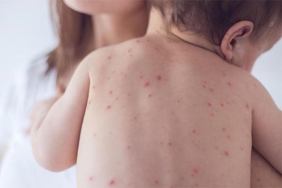 Cẩn trọng với căn bệnh truyền nhiễm đang khiến nhiều trẻ nhập viện