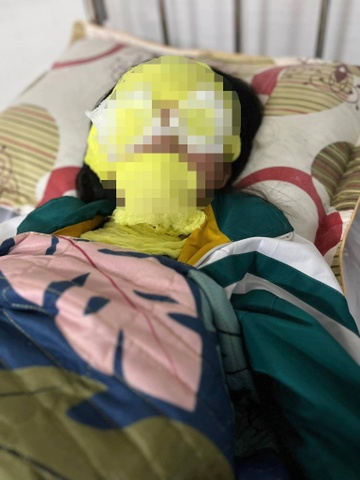 Bóng bay phát nổ khiến bé gái bị bỏng nặng-2