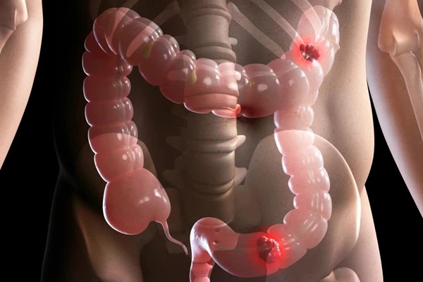 5 dấu hiệu ‘cảnh báo đỏ’ của căn bệnh ung thư đang gia tăng ở người trẻ-1