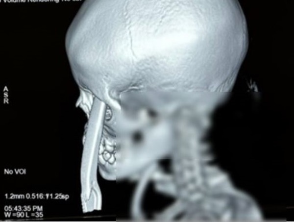 Bé gái bị mảnh vỡ xe đạp xuyên qua hốc mắt-1