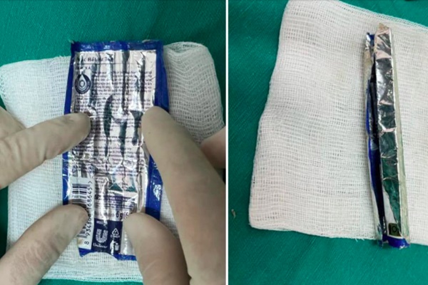 Gắp chiếc vỏ kem xả tóc dài 6cm từ niệu đạo người đàn ông-1