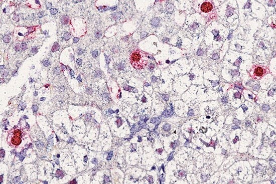 Phát hiện virus mới gây bệnh viêm gan ở người