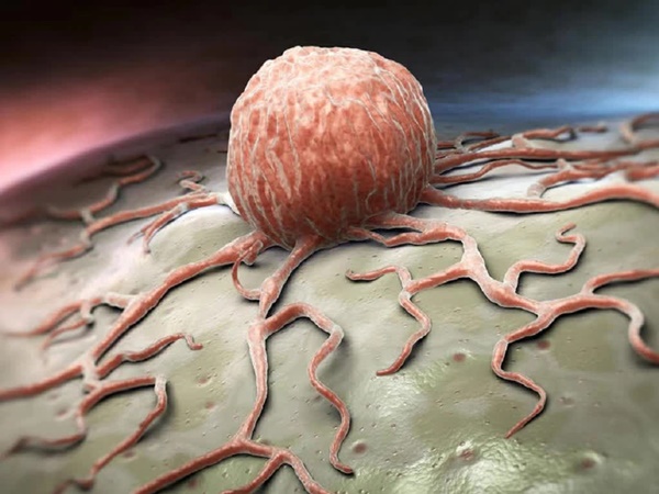 Bác sĩ cảnh báo 1 loại ung thư hay gặp ở người trẻ dưới 40 tuổi, phụ nữ càng không nên xem thường-1