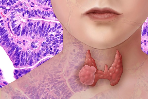 Bác sĩ cảnh báo 1 loại ung thư hay gặp ở người trẻ dưới 40 tuổi, phụ nữ càng không nên xem thường-2