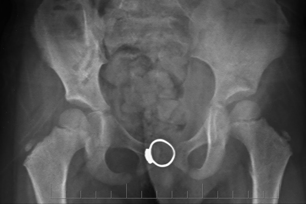 Thấy nhẫn trong vùng kín của bé gái 4 tuổi-1