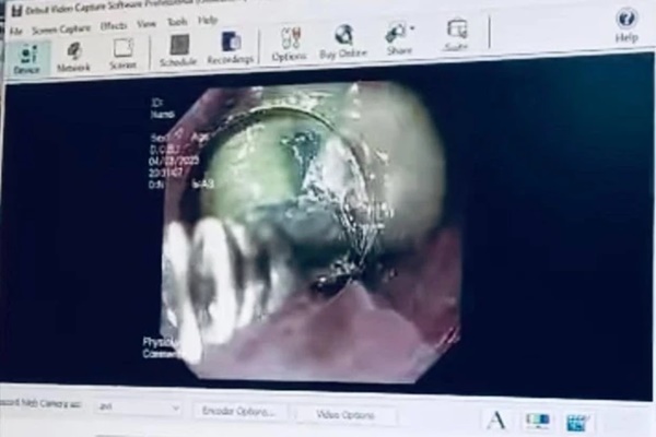 Sản phụ suýt mất mạng vì nuốt túi mật lợn-1