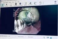 Sản phụ suýt mất mạng vì nuốt túi mật lợn