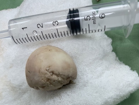 Người đàn ông phải nhập viện cấp cứu sau khi ăn trứng vịt lộn-2