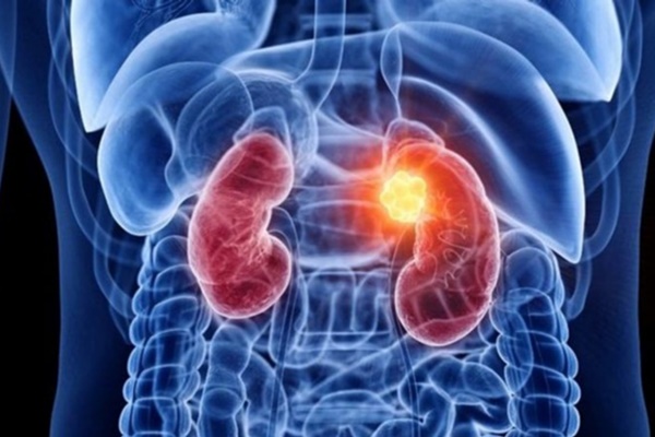 Ngày càng nhiều người mắc sỏi thận, 4 thói quen xấu ai cũng mắc phải này chính là nguyên nhân-6