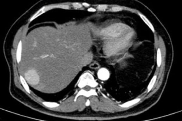 Phát hiện sát thủ ung thư gan khi đi khám tim mạch-1