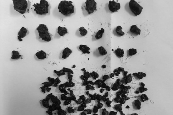 Gần 100 viên sỏi trong mật người phụ nữ 30 tuổi