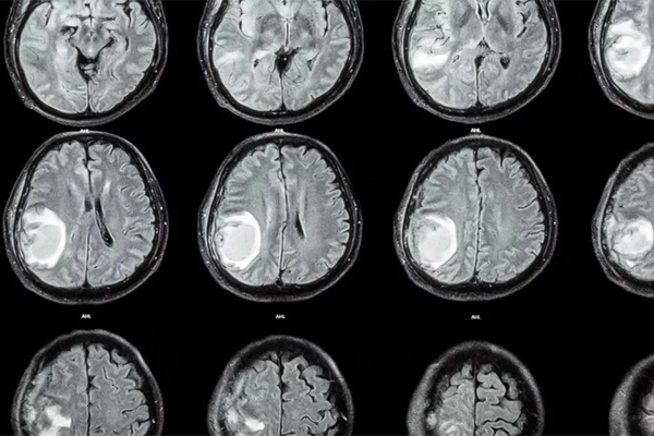 Đầu bé 1 tuổi tự nhiên to lên, bác sĩ lấy ra cả một bào thai trong não-1