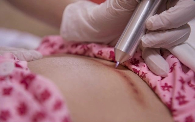 Mẹ bầu có nên chiếu tia plasma sau sinh để mau chóng hồi phục không?-1