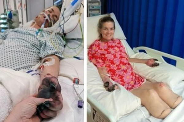 Người phụ nữ phải bỏ 2 chân và ngón tay vì căn bệnh triệu chứng giống cúm nhưng nguy hiểm gấp nhiều lần-1