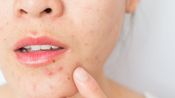 Cách dùng mật ong trị mụn-1