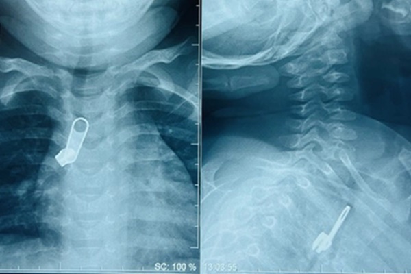 Lý do khiến em bé ở Hà Nội bị nhầm lẫn giới tính-1