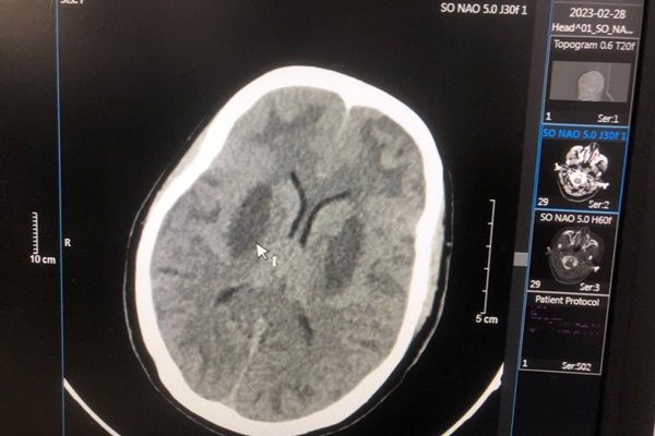 Vụ 37 công nhân bị ngộ độc methanol: Một người tổn thương não nghiêm trọng-1