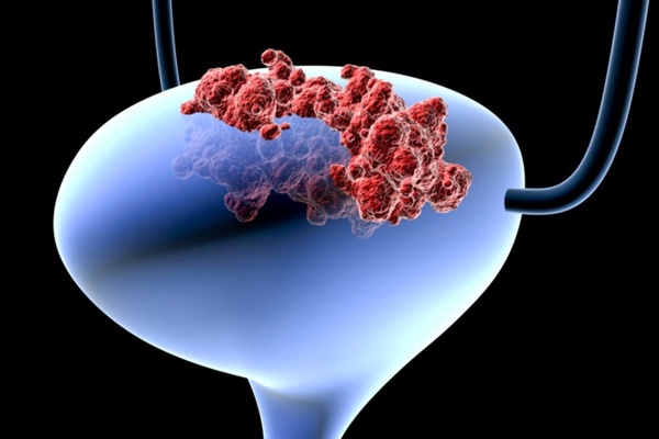 Đột phá: Xét nghiệm nước tiểu dự báo ung thư 12 năm trước khi phát bệnh-1