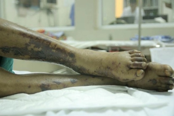 Người đàn ông nhiễm liên cầu khuẩn lợn nguy kịch dù không ăn tiết canh-1