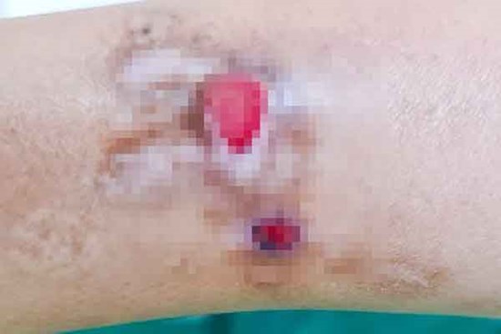 Kỳ lạ: Người phụ nữ ở TP.HCM tự cào rách da mỗi lần căng thẳng
