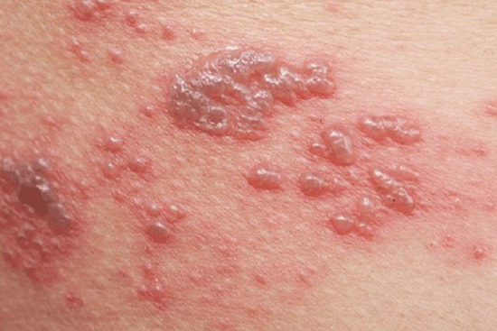 Mẹo chữa zona thần kinh đơn giản tại nhà, đem lại hiệu quả cao nhưng ít người biết tới