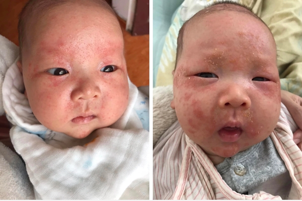 Tắm lá, bé trai 8 tháng tuổi nứt da đầu, bong tróc khắp mặt-3