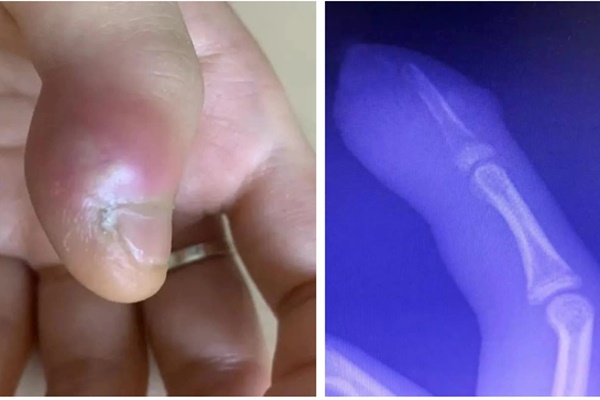 Nam sinh 13 tuổi ngón tay sưng tấy, có nguy cơ phải cắt cụt chi vì thói quen nhiều người làm mỗi khi căng thẳng-1