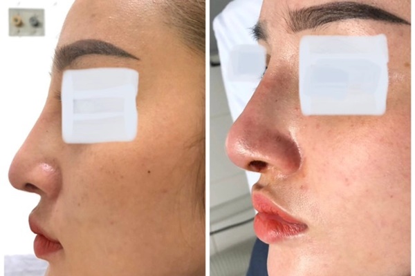 Nữ sinh 15 tuổi xỏ lỗ tai gây viêm màng sụn, biến dạng vành tai, chuyên gia cảnh báo-3