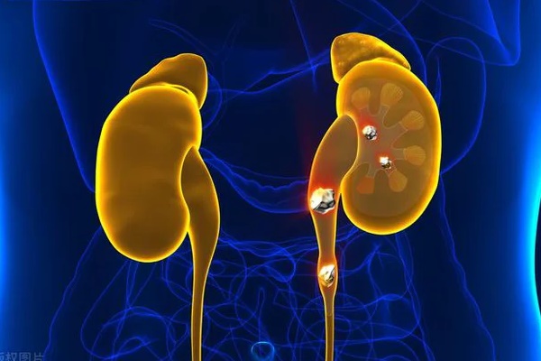 Ngày càng nhiều người mắc sỏi thận, 4 thói quen xấu ai cũng mắc phải này chính là nguyên nhân-2