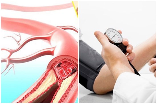 Cách đơn giản chữa cao huyết áp tại nhà, hiệu quả nhanh chóng đỡ bị phụ thuộc vào thuốc