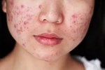 5 hệ luỵ đáng sợ khi dùng mỹ phẩm kém chất lượng