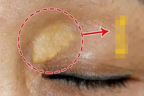 8 dấu hiệu bệnh tim trên khuôn mặt, người tinh ý dễ dàng nhận ra-1