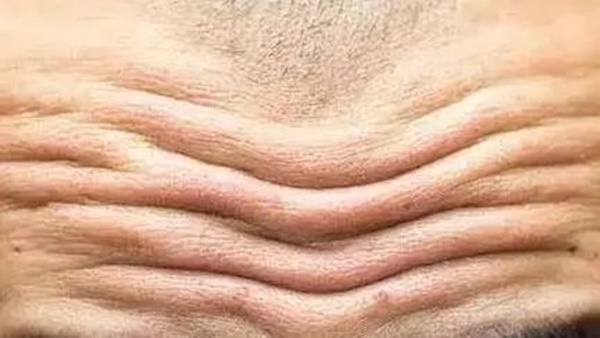 8 dấu hiệu bệnh tim trên khuôn mặt, người tinh ý dễ dàng nhận ra-2