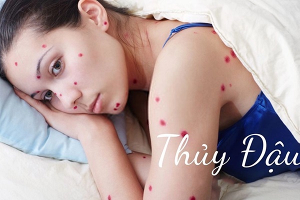 Bệnh thủy đậu đang bùng phát: Bị thủy đậu bao nhiêu ngày thì khỏi, có bị lại lần 2 không?-1