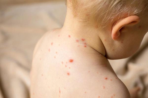 Bác sĩ hướng dẫn cách chăm sóc trẻ mắc bệnh thủy đậu-4
