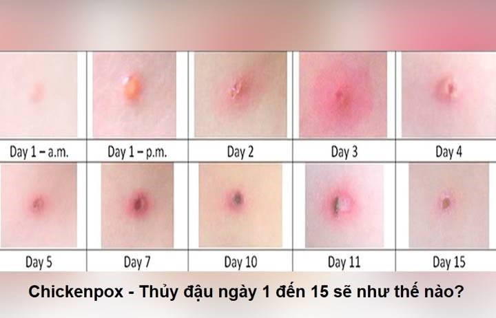Con có những dấu hiệu này mẹ cần cho bé đi khám gấp vì nguy cơ bị thủy đậu-1