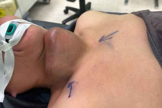 Áp xe tuyến giáp do tự ý đắp thuốc nam