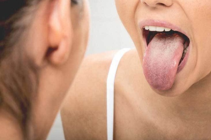 Triệu chứng ung thư lưỡi-1