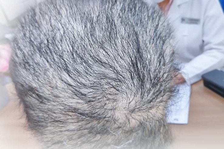 Áp lực thi cử, cô gái rụng hết tóc-1