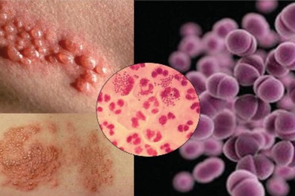 Những dấu hiệu nào cần nghĩ đến nguy cơ mắc bệnh lậu?-1