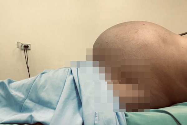Mang khối u nặng 10kg nhưng tưởng béo bụng-1