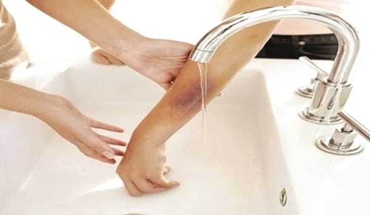 Những mẹo vặt đơn giản chữa bỏng hiệu quả mà bạn cần biết-1
