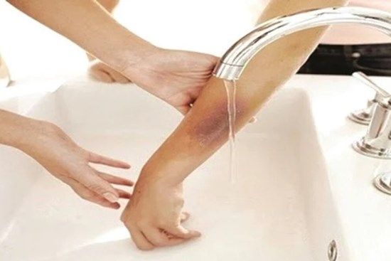 Những mẹo vặt đơn giản chữa bỏng hiệu quả mà bạn cần biết