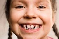 Bác sĩ răng hàm mặt chia sẻ: Điều bố mẹ cần làm trước khi cho con niềng răng, thời điểm vàng nên thực hiện