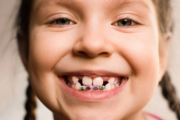 Bác sĩ răng hàm mặt chia sẻ: Điều bố mẹ cần làm trước khi cho con niềng răng, thời điểm vàng nên thực hiện-3