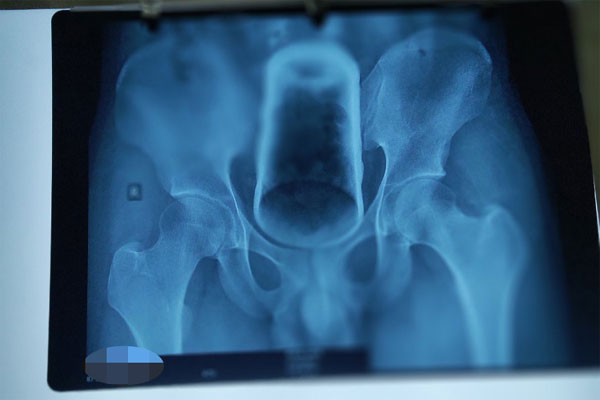 Tai nạn khó tin khi quý ông cố ‘làm đẹp cậu nhỏ-2