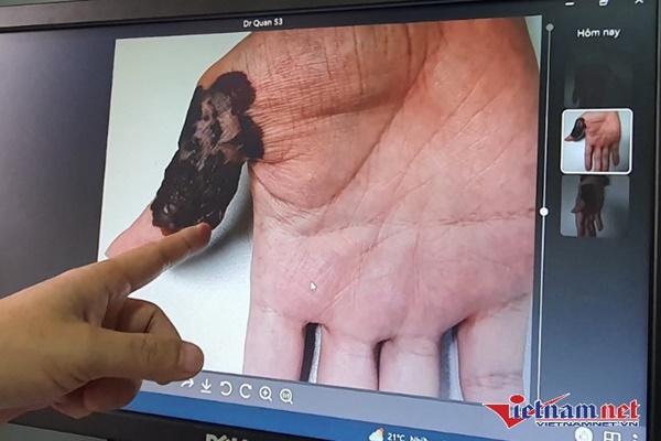Nam thanh niên Hà Nội phát hiện ung thư da từ nốt ruồi trên bàn tay-1